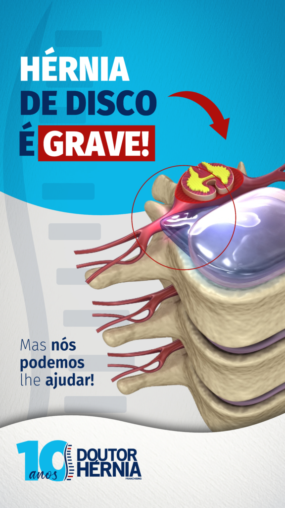 HÉRNIA DE DISCO TEM TRATAMENTO SEM CIRURGIA